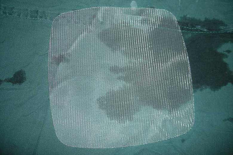 Canadian hernia mesh lawsuit lawyer for product liability claims