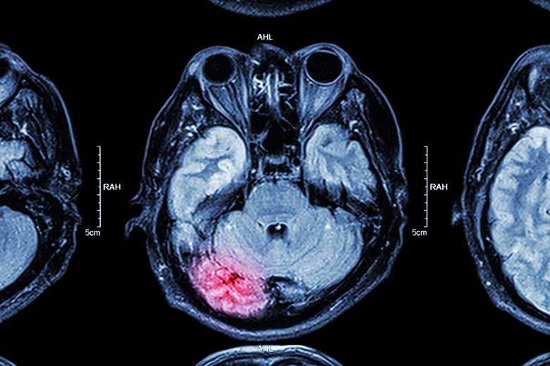 Brain Injury Claims image